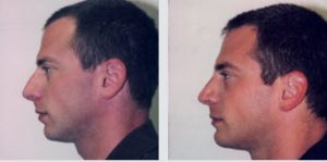 male rhinoplasty before and after
