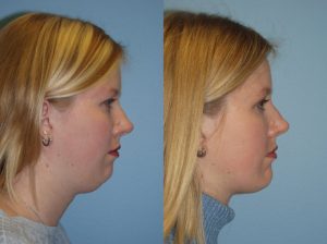 face lipo dr ackerman