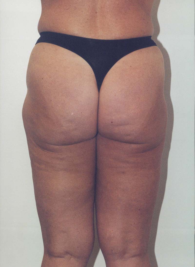 ba bodycontouring01 before