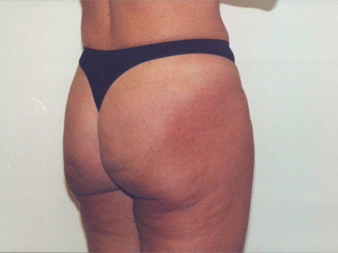 Brazilian Butt Lift Patient 01 - Before - 1