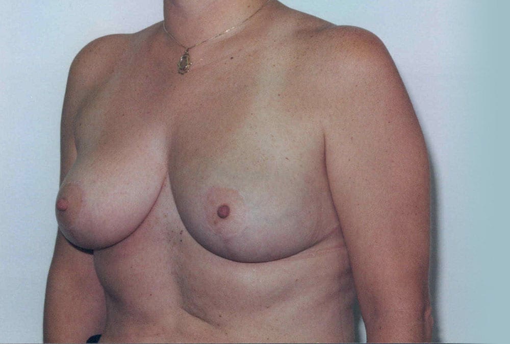 ba breast reduction01 after