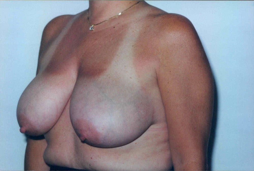 ba breast reduction01 before