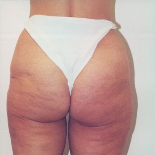 Body Contouring Patient 22 - Before - 1