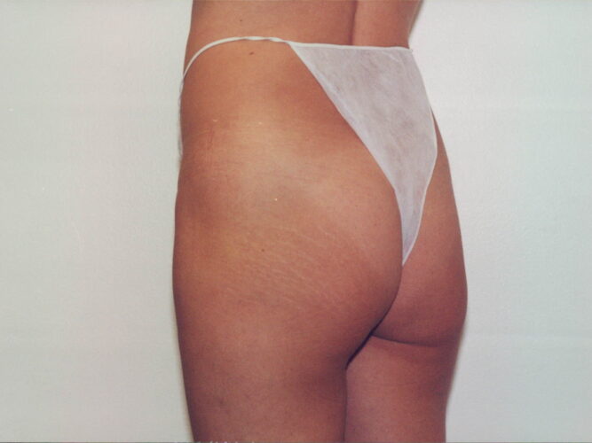 Body Contouring Patient 21 - Before - 1