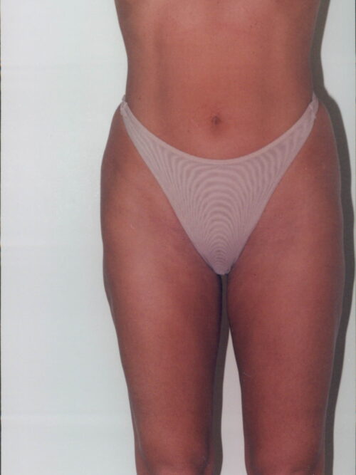 Body Contouring Patient 28 - After - 1