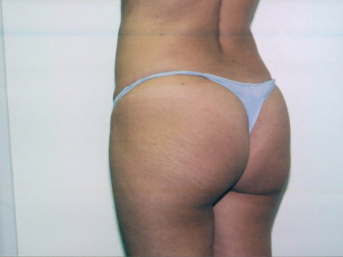 Body Contouring Patient 21 - After - 1
