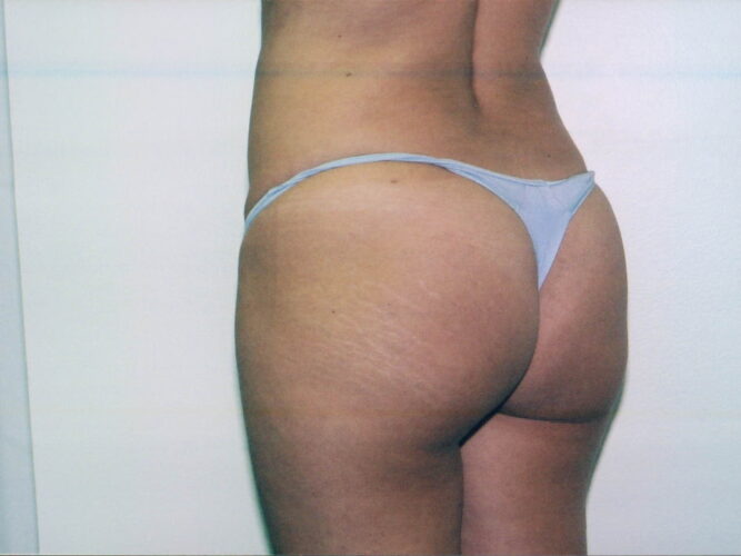 Body Contouring Patient 21 - After - 1