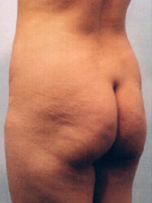 Body Contouring Patient 20 - Before - 1