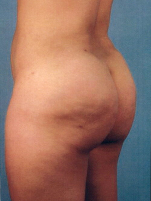 Body Contouring Patient 20 - After - 1