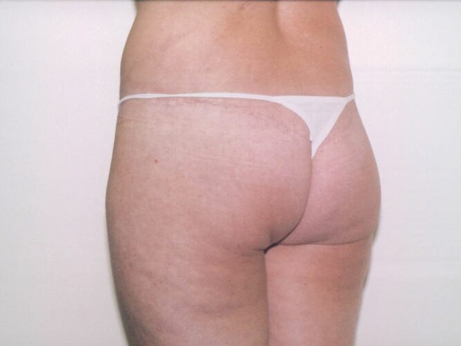 Body Contouring Patient 25 - After - 1