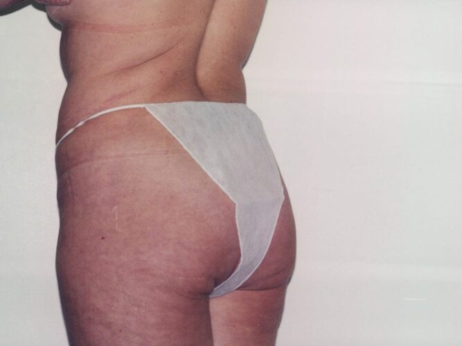 Body Contouring Patient 25 - Before - 1