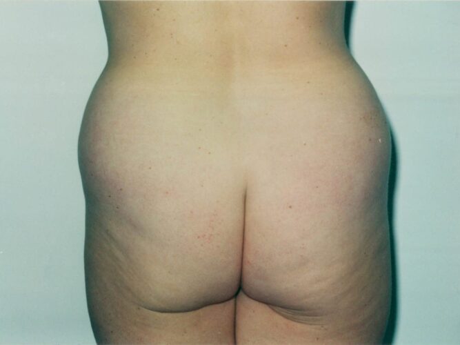 Body Contouring Patient 18 - Before - 1