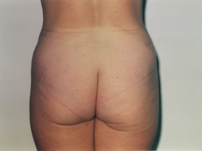 Body Contouring Patient 18 - After - 1