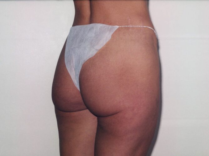 Body Contouring Patient 24 - Before - 1