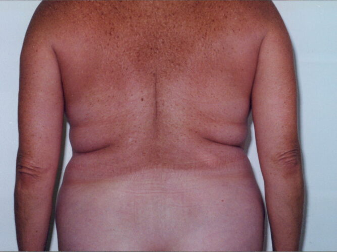 Body Contouring Patient 14 - Before - 1