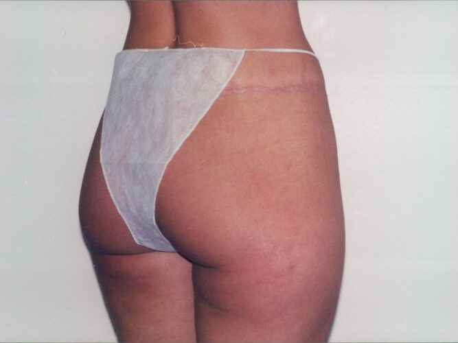 Body Contouring Patient 24 - After - 1