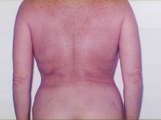 Body Contouring Patient 14 - After - 1