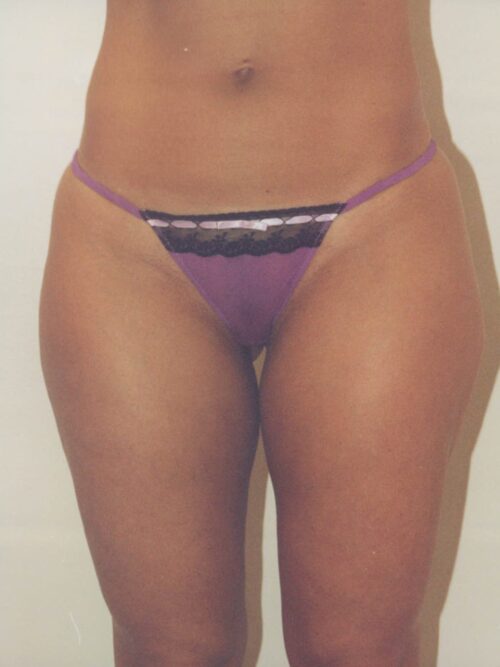 Body Contouring Patient 13 - Before - 1