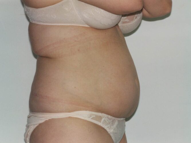 Body Contouring Patient 12 - Before - 1