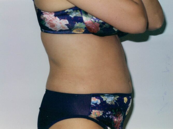 Body Contouring Patient 12 - After - 1