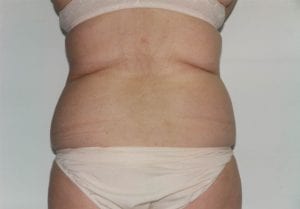 Body Contouring Patient 12 - Before - 2 Thumbnail