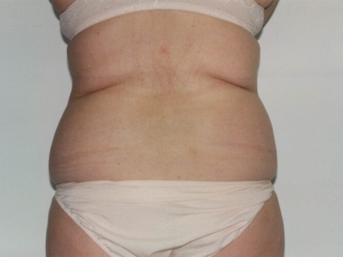 Body Contouring Patient 12 - Before - 2