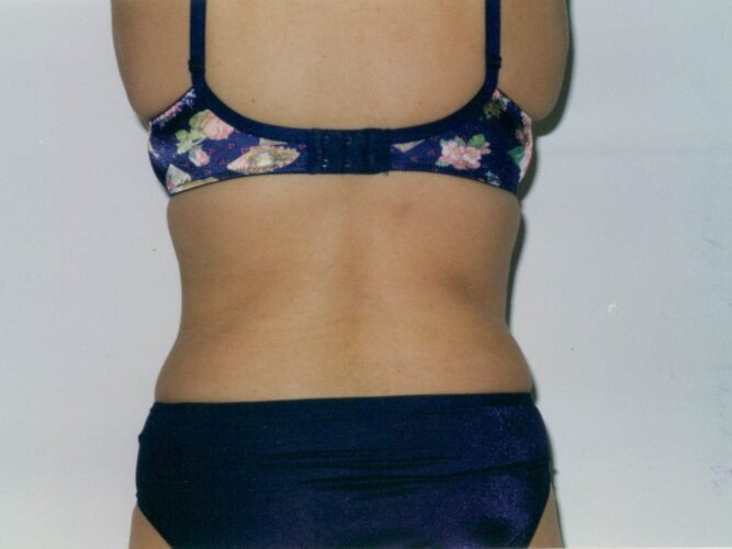 Body Contouring Patient 12 - After - 2