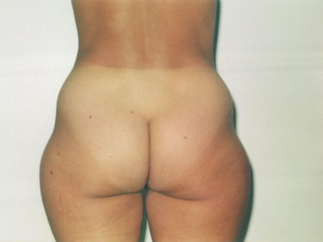 Body Contouring Patient 11 - Before - 1