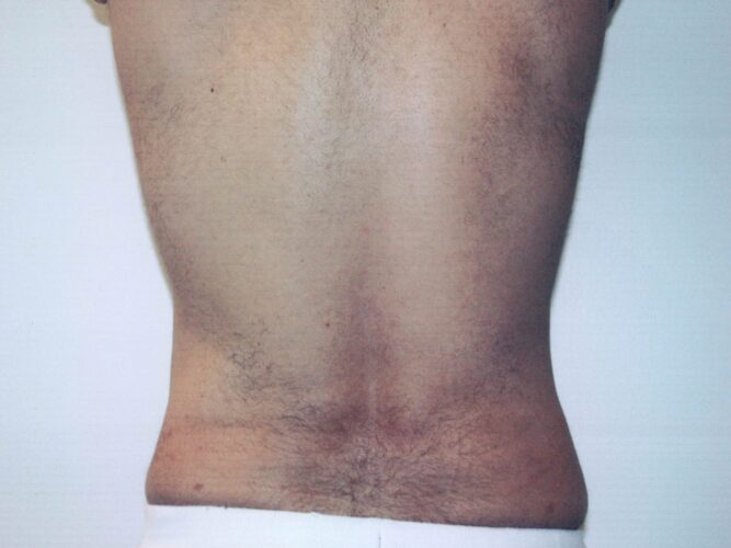 Body Contouring Patient 08 - After - 2