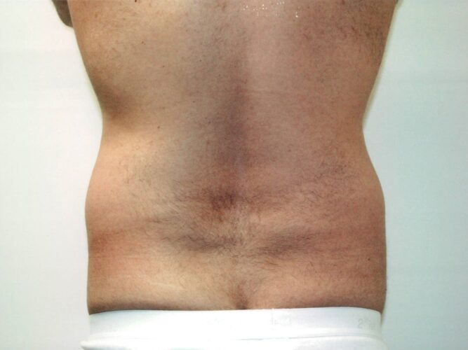 Body Contouring Patient 08 - Before - 2