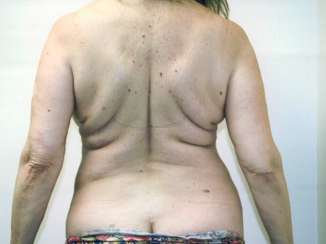 Body Contouring Patient 07 - Before - 1