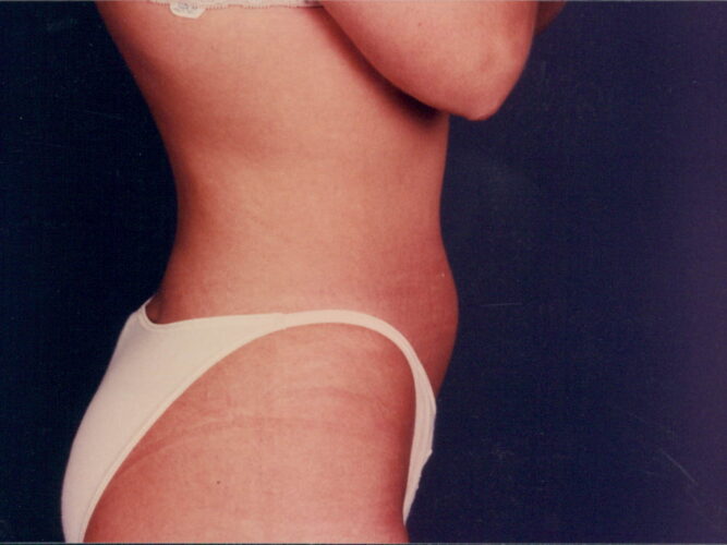 Body Contouring Patient 03 - Before - 1