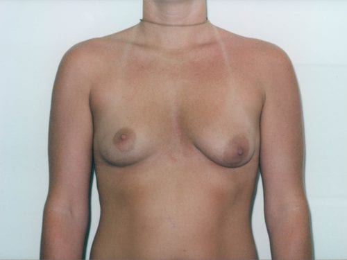 breast augmentation 1 00116