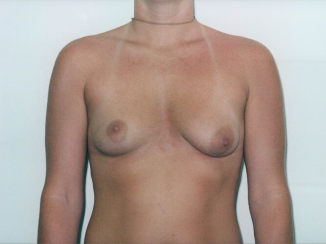 Breast Augmentation Patient 21 - Before - 1