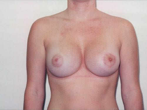 breast augmentation 1 00126