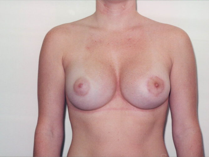 Breast Augmentation Patient 21 - After - 1