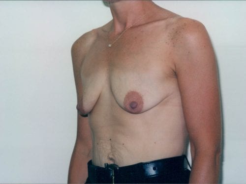 breast augmentation 1 00193