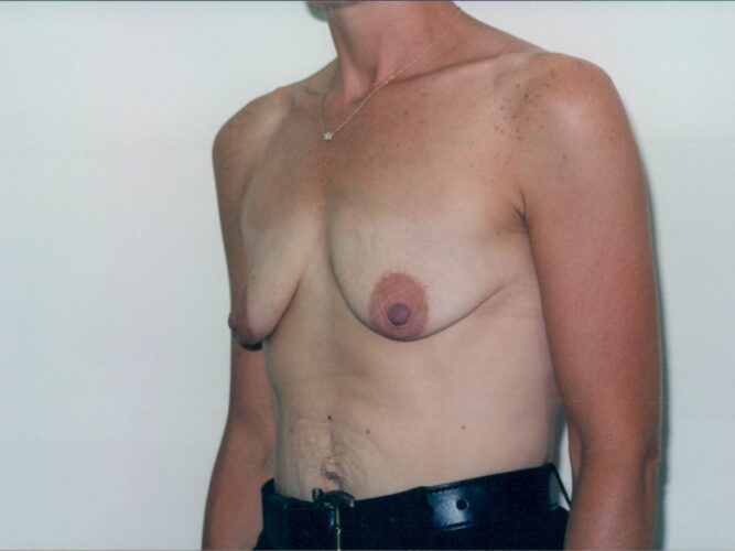 Breast Lift with Implants Patient 73 - Before - 1