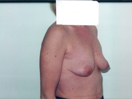 breast augmentation 1 00214