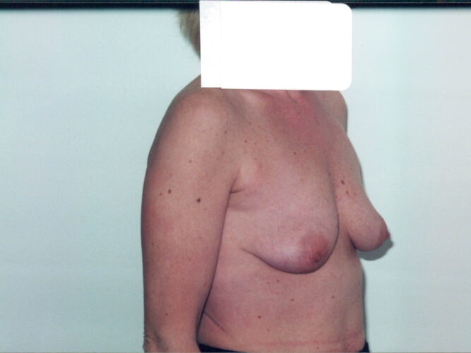 Breast Lift with Implants Patient 26 - Before - 1