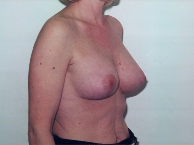 Breast Lift with Implants Patient 26 - After - 1