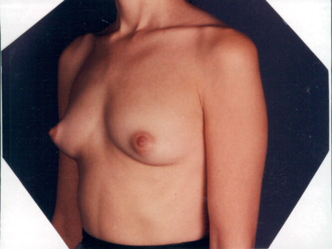 Breast Augmentation Patient 16 - Before - 1