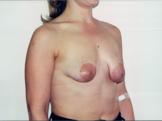 Breast Augmentation Patient 04 - Before - 1