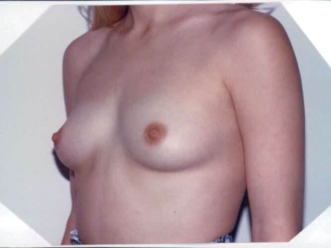 Breast Augmentation Patient 11 - Before - 1