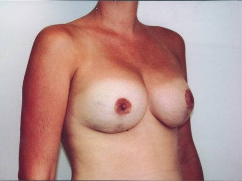 breast augmentation 1 0046