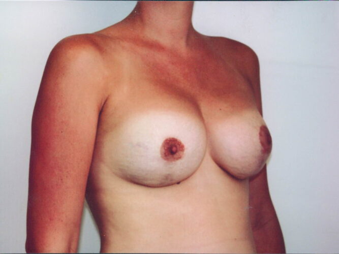 Breast Lift with Implants Patient 24 - After - 1
