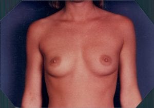 Breast Augmentation Patient 10 - Before - 1 Thumbnail