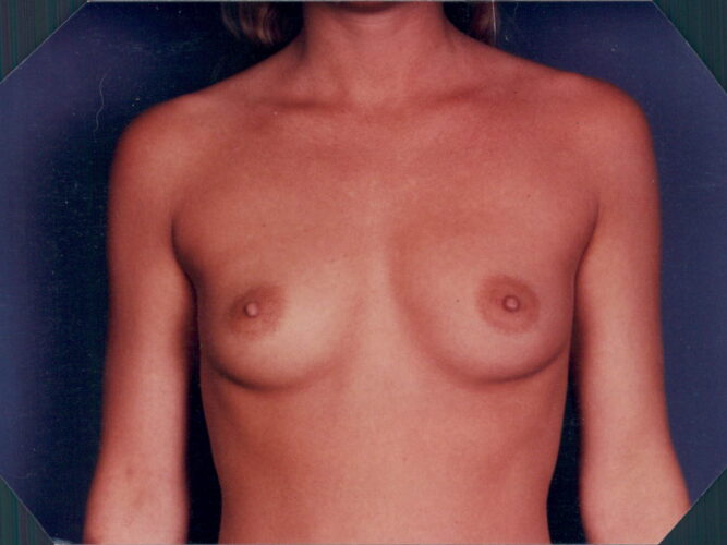 Breast Augmentation Patient 10 - Before - 1