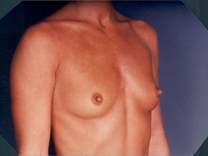 Breast Augmentation Patient 09 - Before - 1
