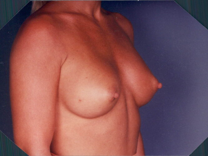 Breast Augmentation Patient 09 - After - 1